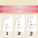 آشنایی با مراحل سرطان پستان