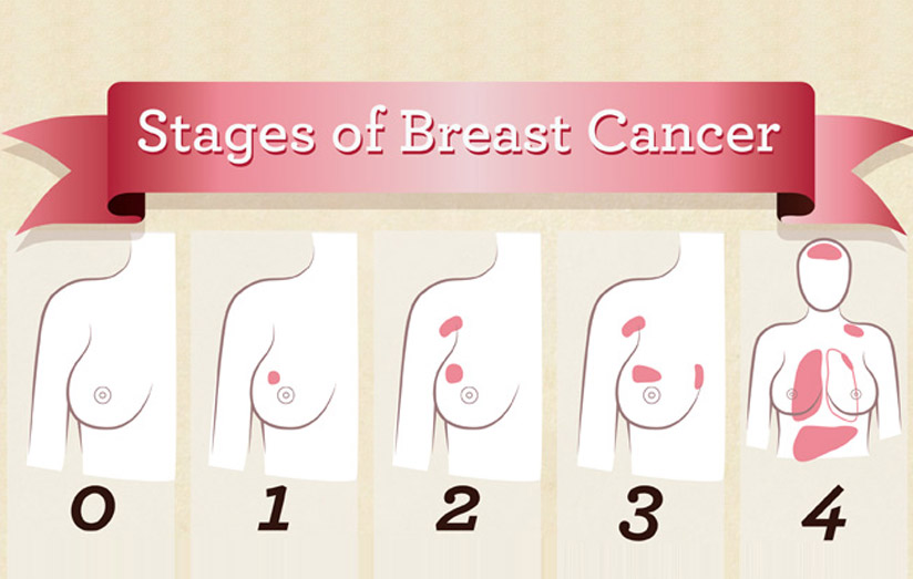 آشنایی با مراحل سرطان پستان