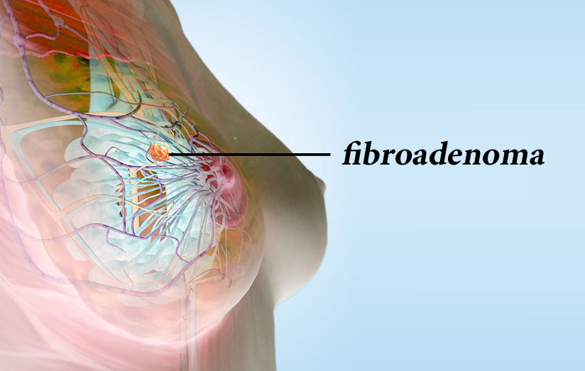 هر آنچه باید درباره فیبروآدنوما بدانید